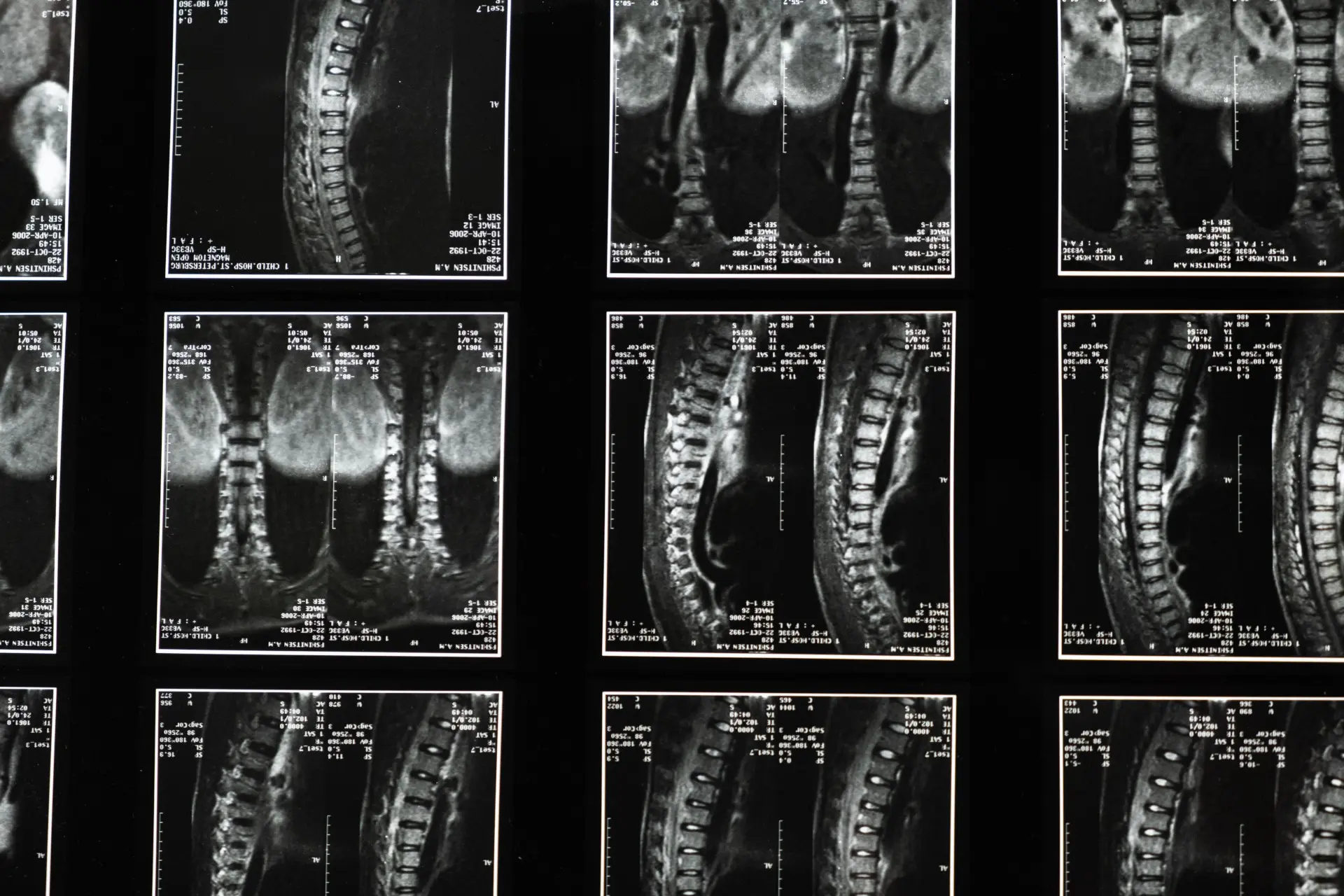 Degenerative Disc